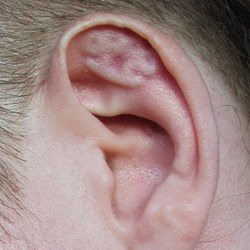 Ear helix subdermal \
