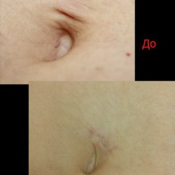 Коррекция формы пупка